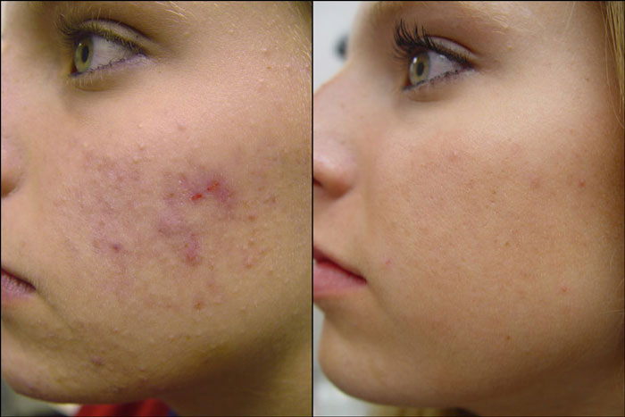 pittsburgh acne treatment